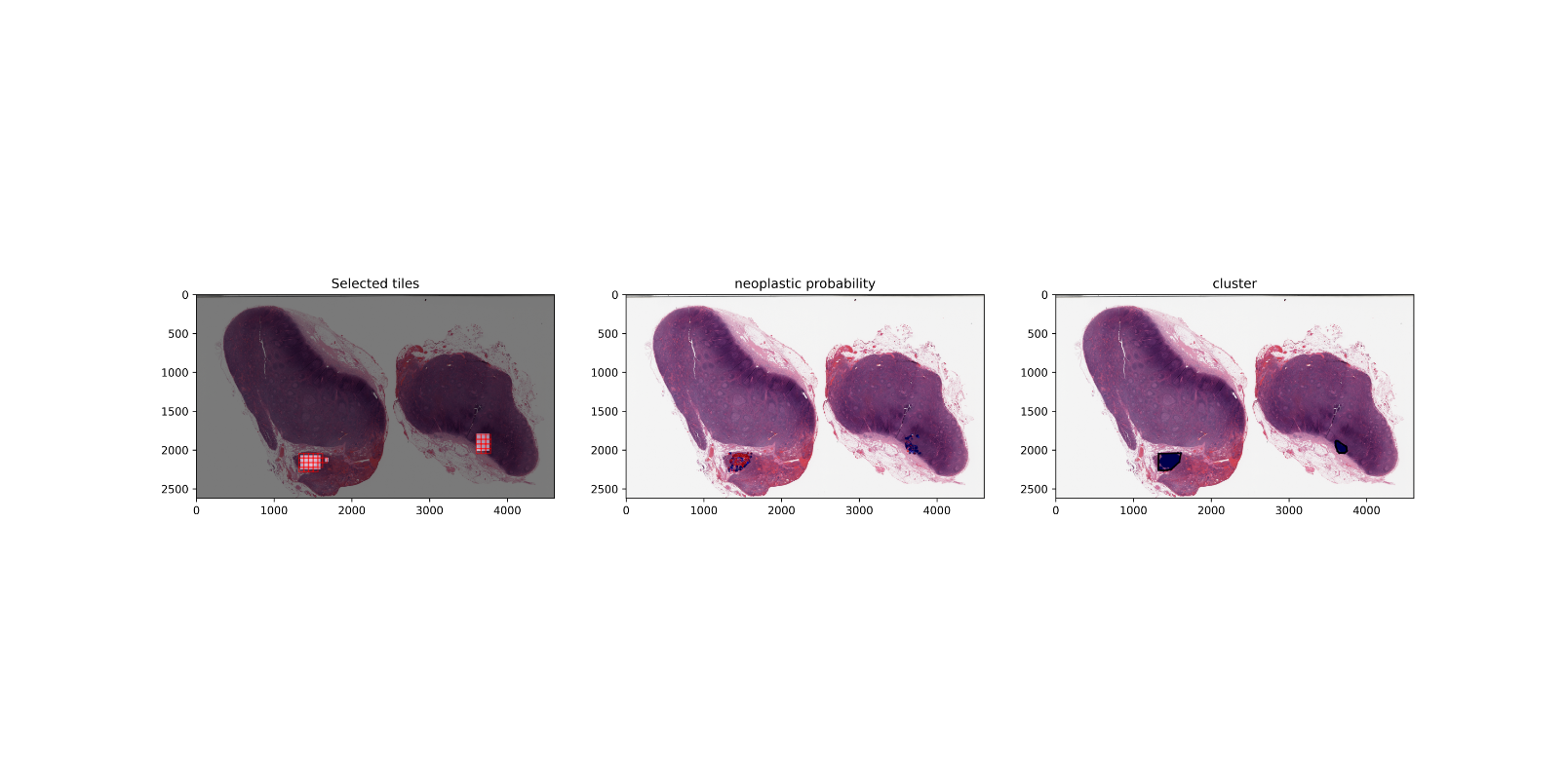 Directed inference pipeline: tile selection, neoplastic probability, cluster map